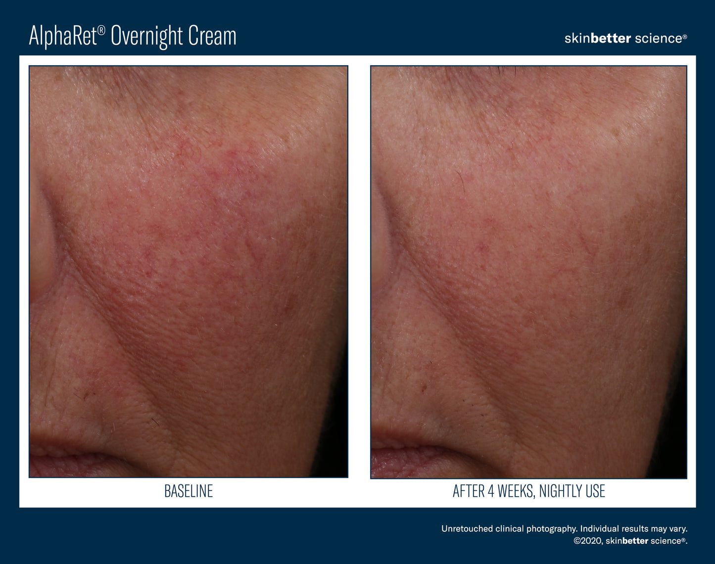 Skinbetter Science AlphaRet Overnight Cream