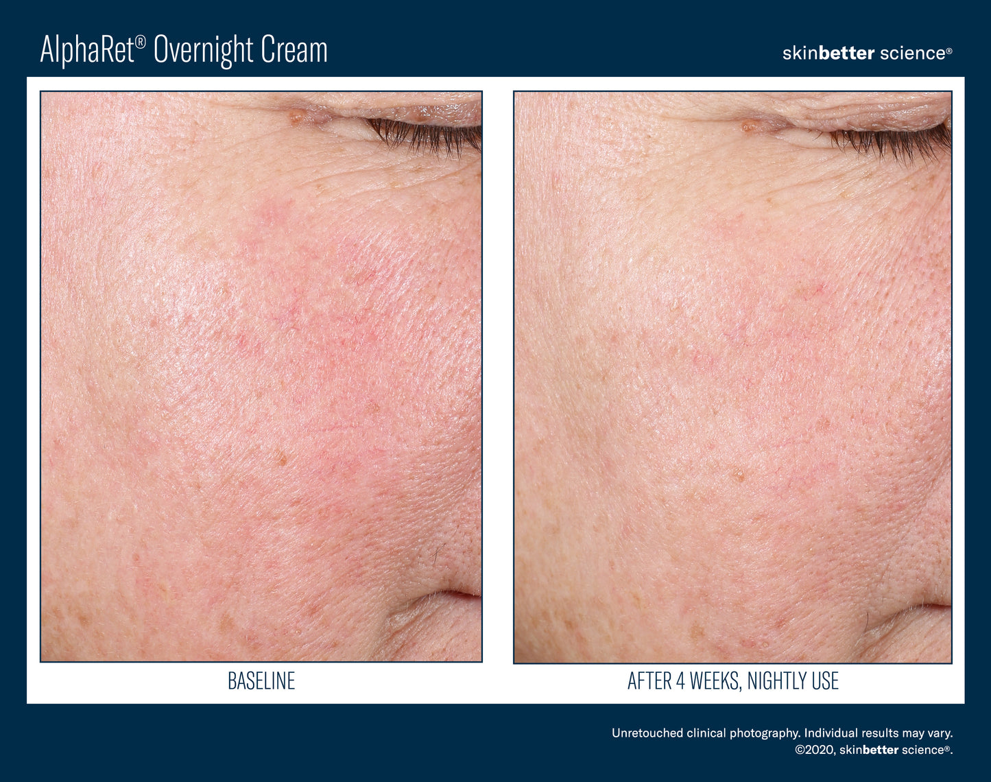 Skinbetter Science AlphaRet Overnight Cream