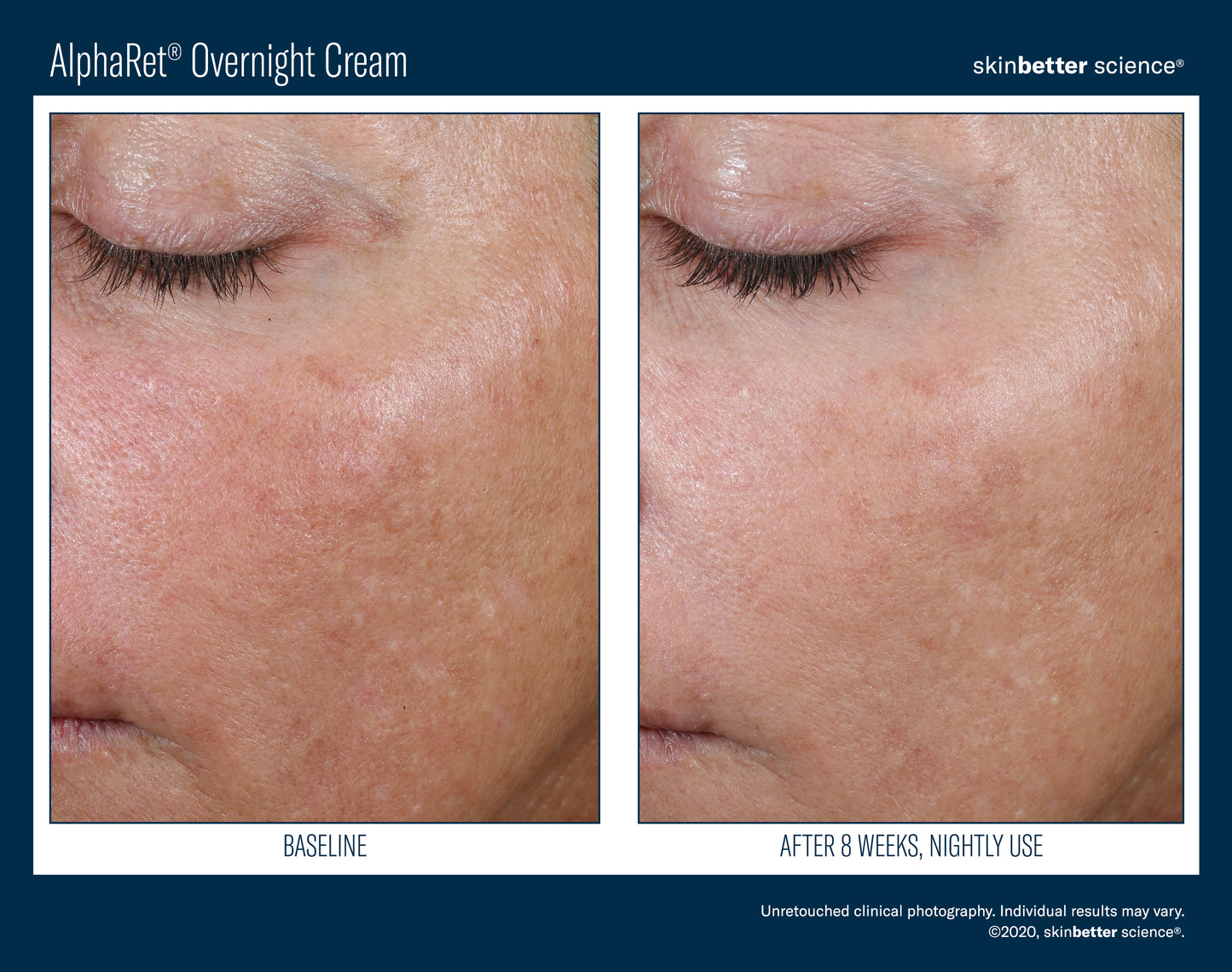 Skinbetter Science AlphaRet Overnight Cream