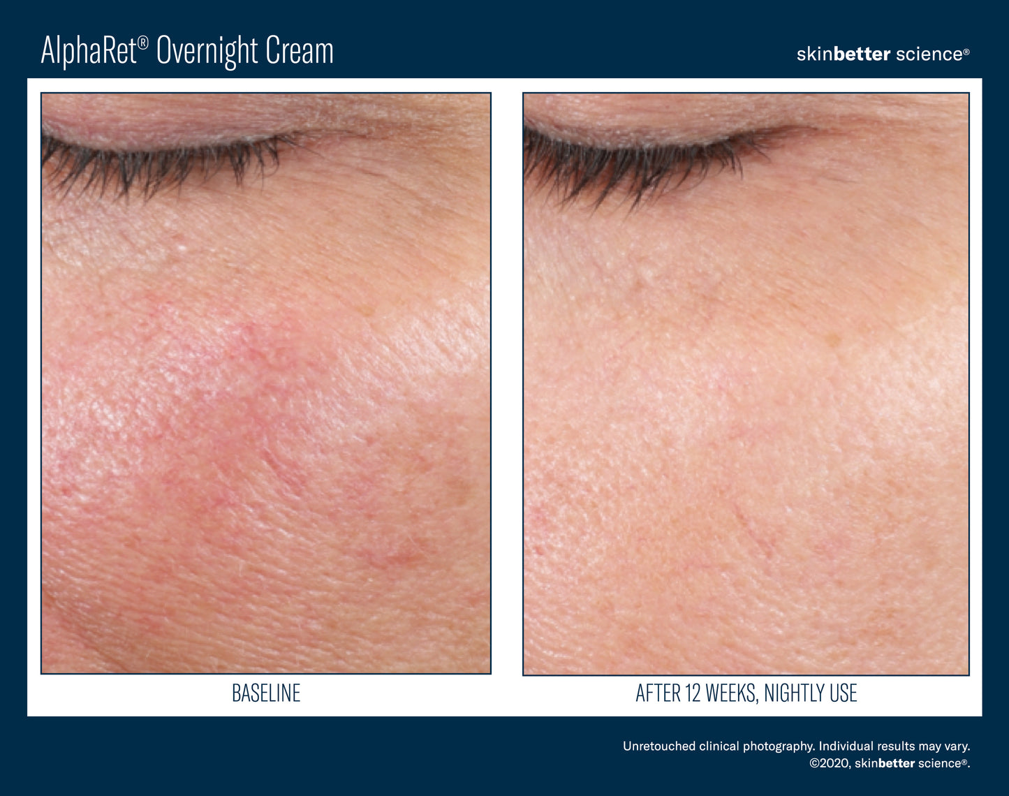 Skinbetter Science AlphaRet Overnight Cream
