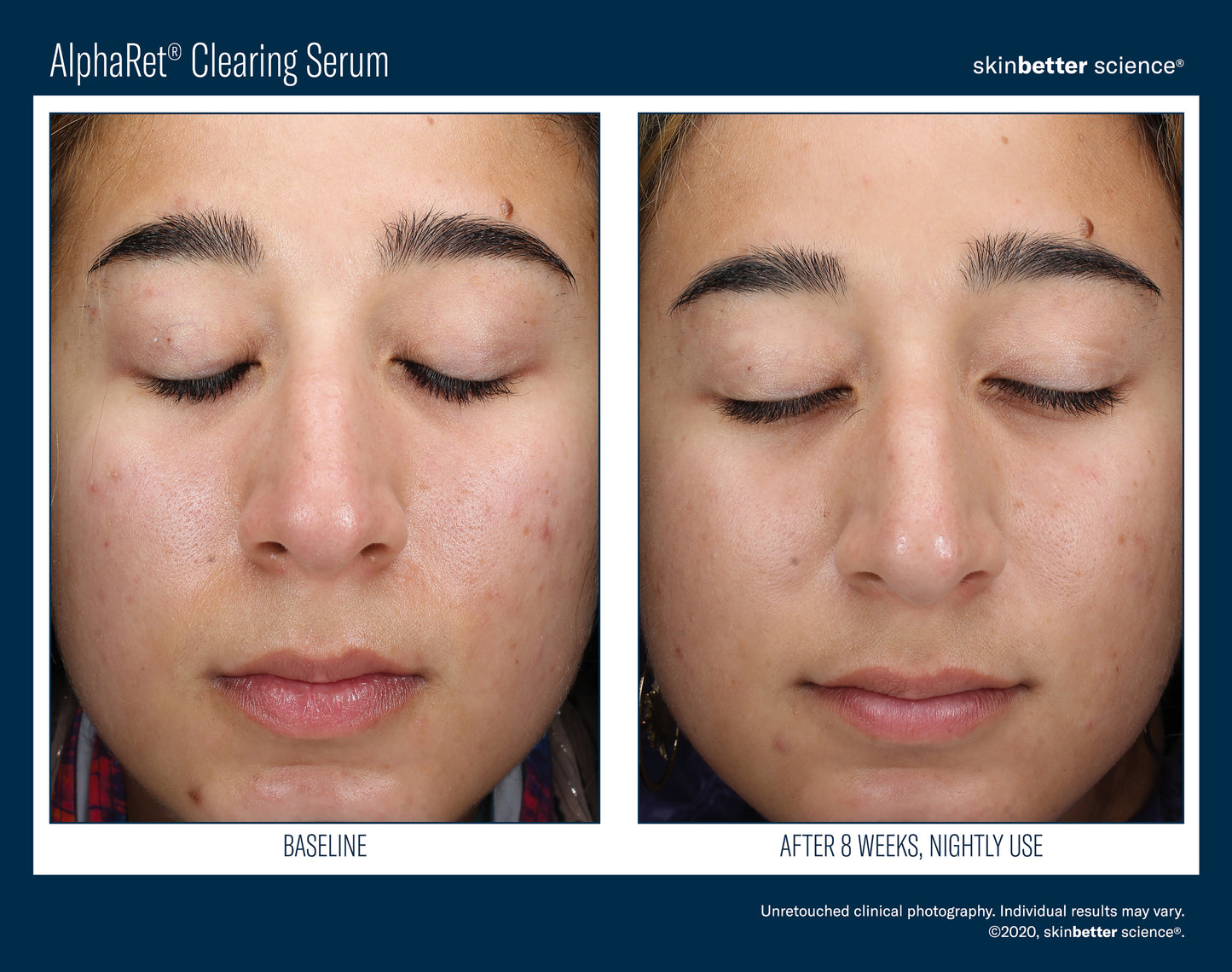 Skinbetter Science AlphaRet Clearing Serum (30ml)