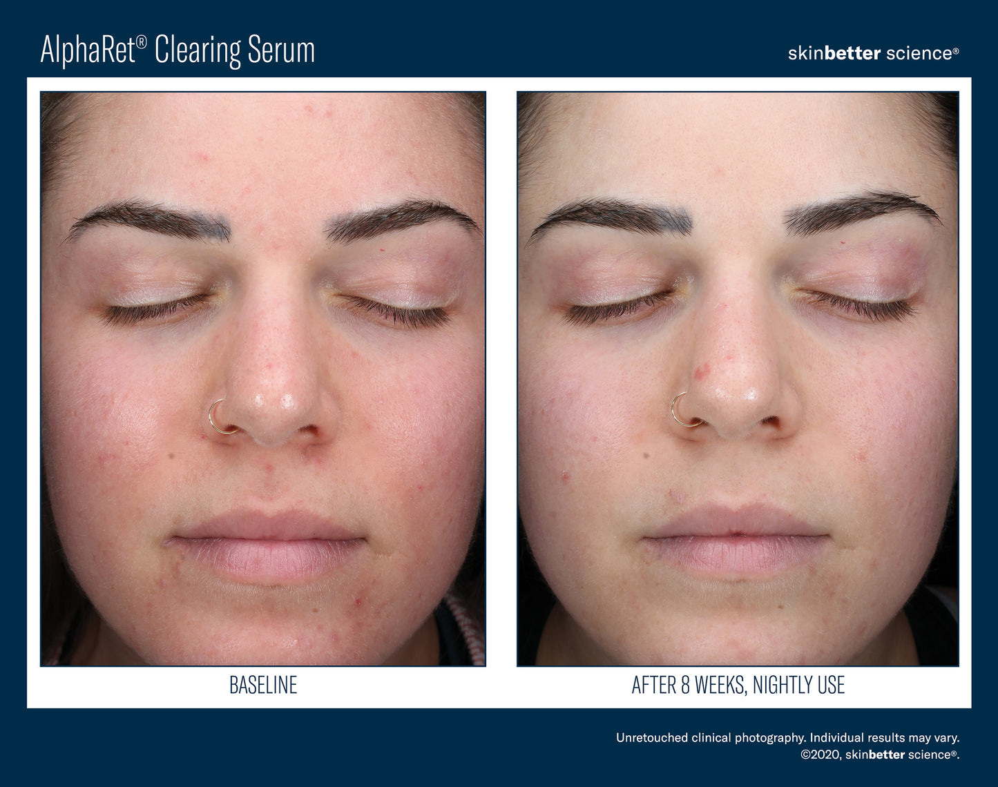 Skinbetter Science AlphaRet Clearing Serum (30ml)