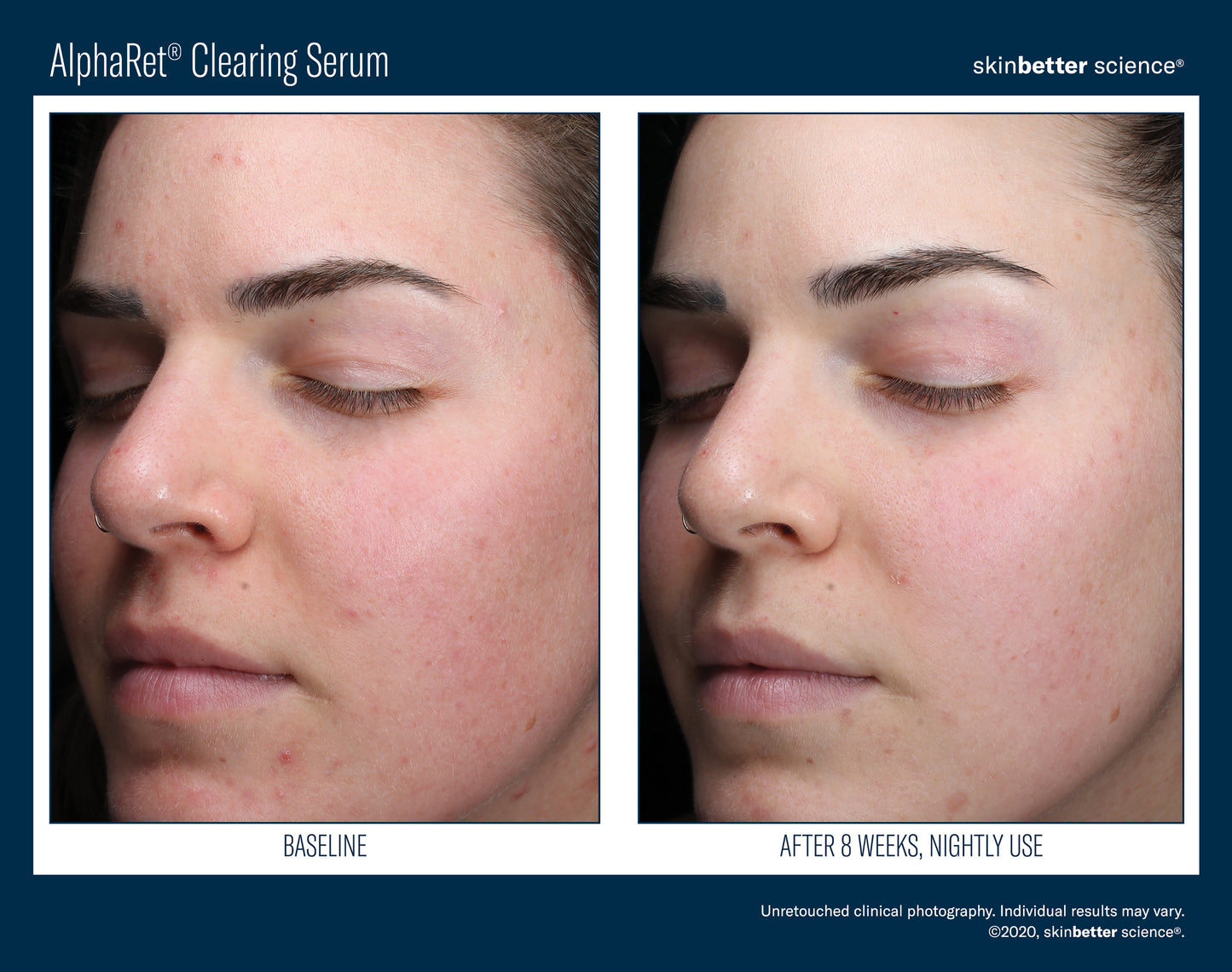 Skinbetter Science AlphaRet Clearing Serum (30ml)