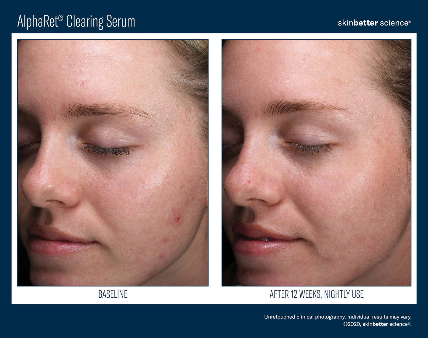 Skinbetter Science AlphaRet Clearing Serum (30ml)