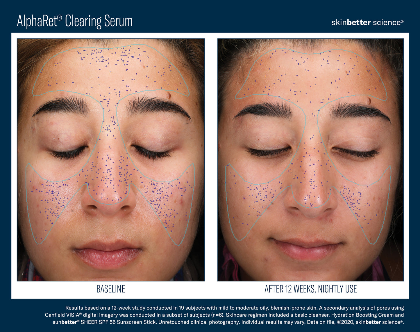 Skinbetter Science AlphaRet Clearing Serum (30ml)