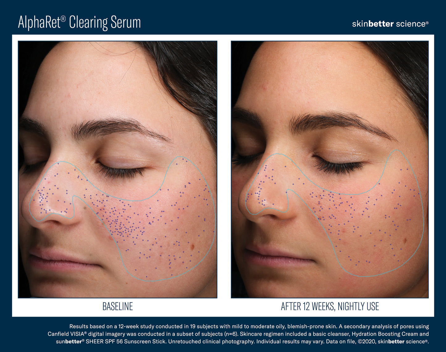Skinbetter Science AlphaRet Clearing Serum (30ml)