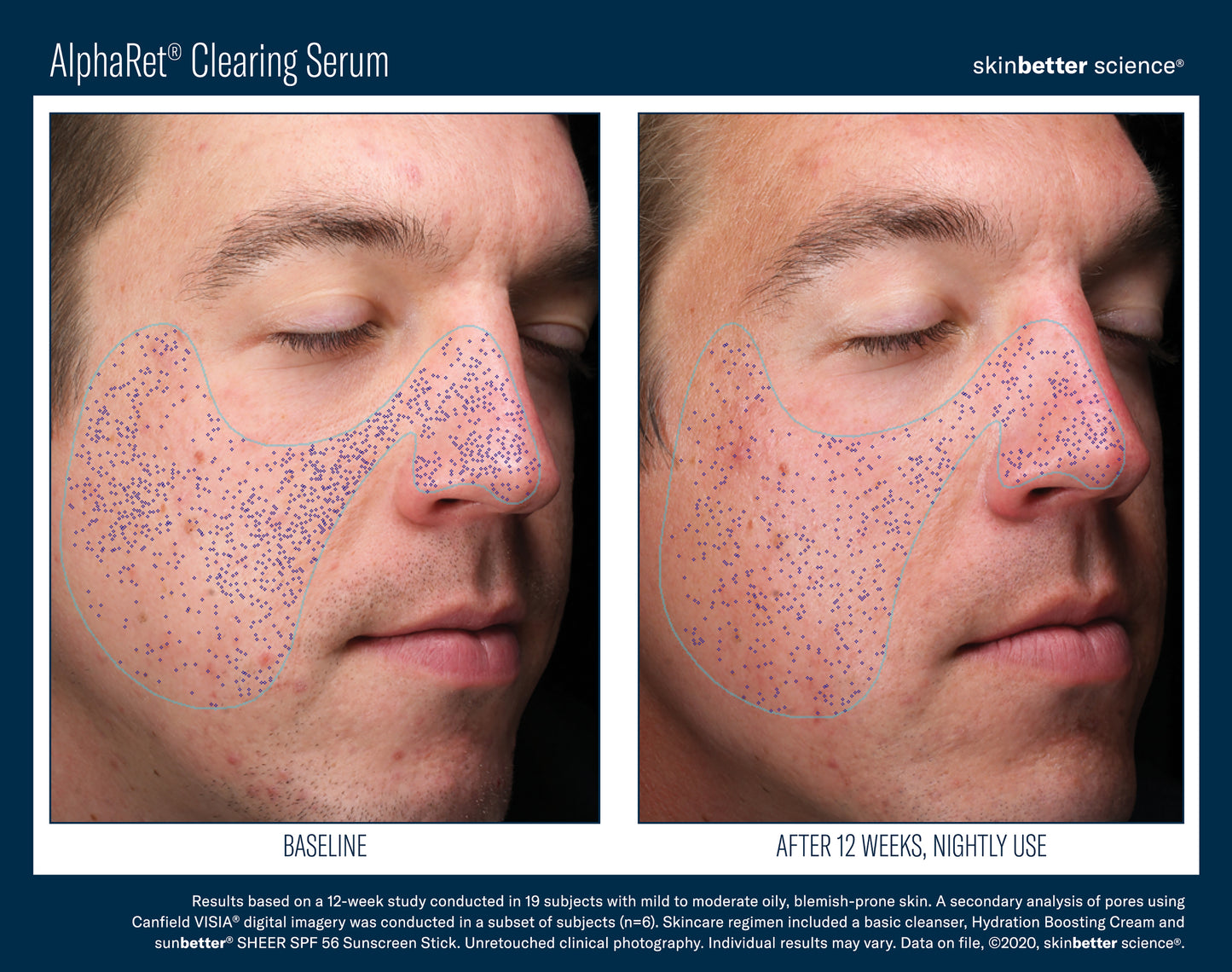 Skinbetter Science AlphaRet Clearing Serum (30ml)