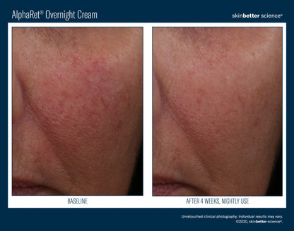 Skinbetter Science AlphaRet Overnight Cream