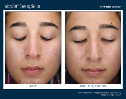 Skinbetter Science AlphaRet Clearing Serum (30ml)