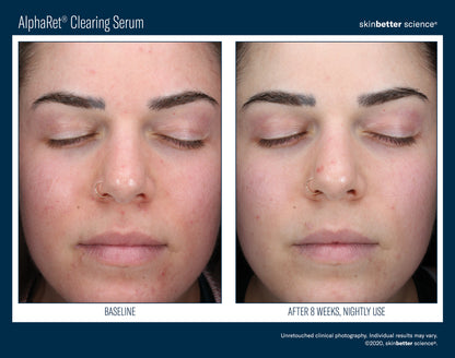 Skinbetter Science AlphaRet Clearing Serum (30ml)