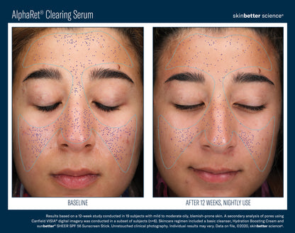 Skinbetter Science AlphaRet Clearing Serum (30ml)