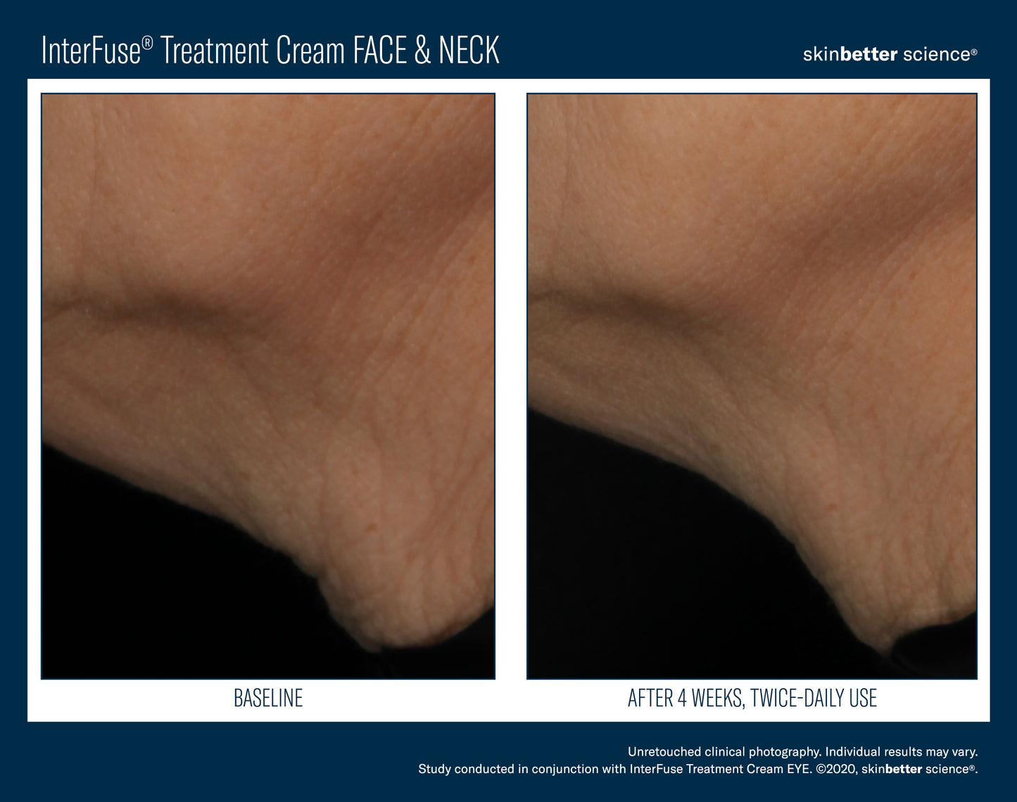 Skinbetter Science InterFuse Treatment Cream Face & Neck – (30 ml / 50 ml)