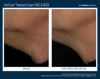 Skinbetter Science InterFuse Treatment Cream Face & Neck – (30 ml / 50 ml)