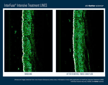Skinbetter Science InterFuse Intensive Treatment LINES 15ml/30ml