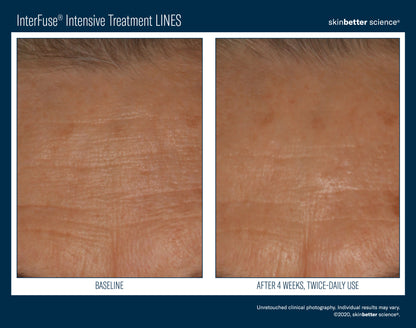 Skinbetter Science InterFuse Intensive Treatment LINES 15ml/30ml