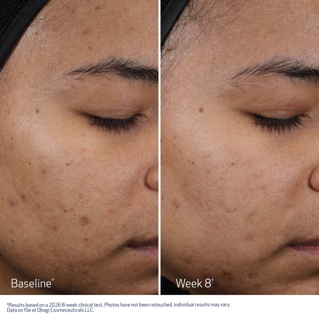 Obagi CLENZIderm M.D. Resurfacing Multi Acid Peel Pads (30 Pads)